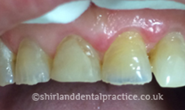 Before - Shirland Dental