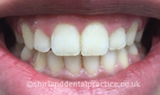 After - Shirland Dental