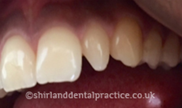 Before - Shirland Dental