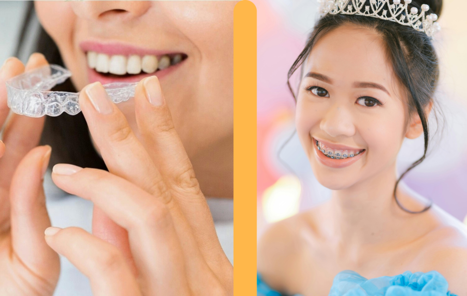 Is Invisalign More Comfortable Than Braces?