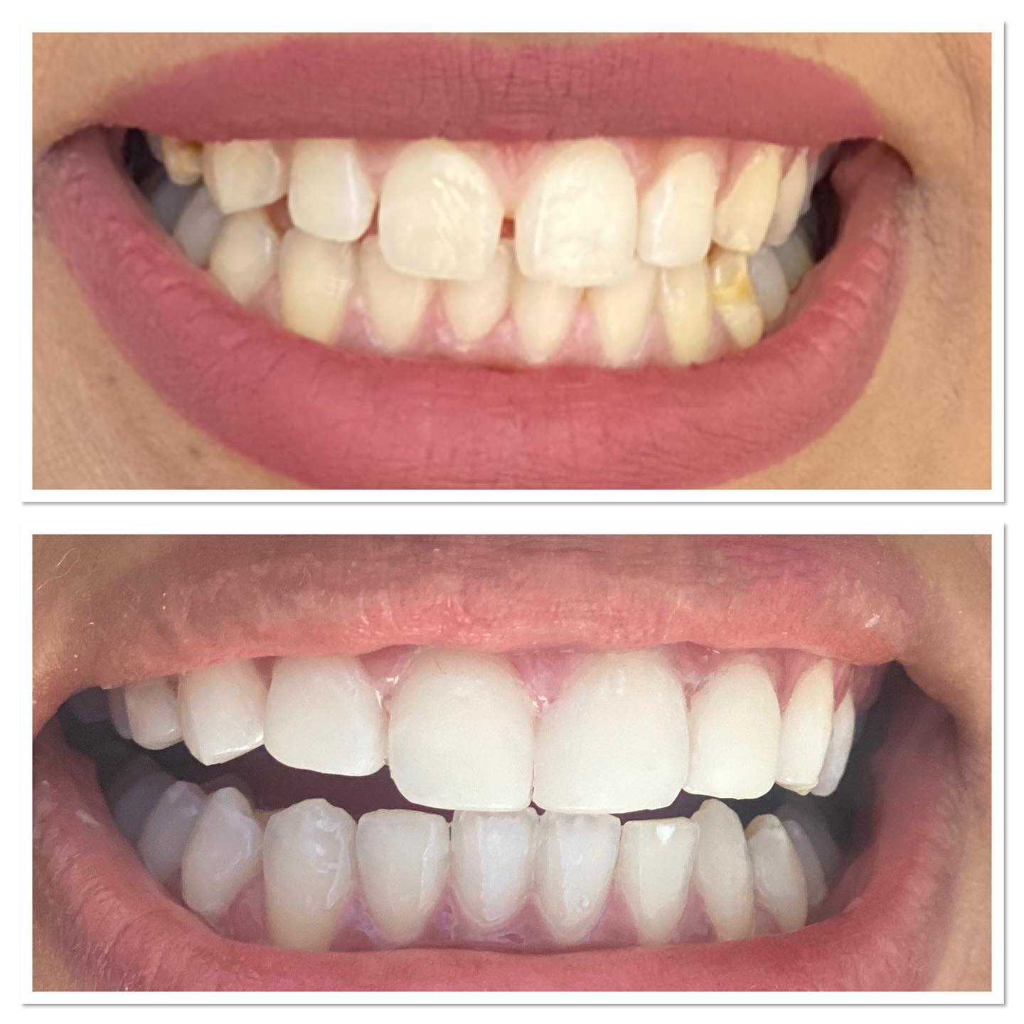Composite Bonding for Crooked Teeth Shirland Dental Practice