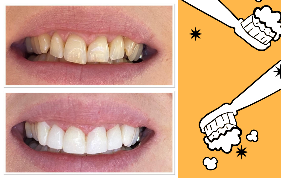 Composite bonding for crooked teeth